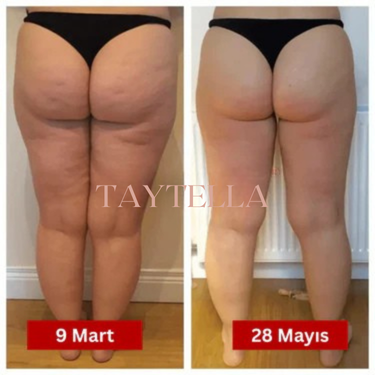 3'lü Etki Taytı Lipödem, Selülit, Varis Taytella™